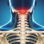 uncodiscarthrose image arthrose cervicale douleurs ostéophytes